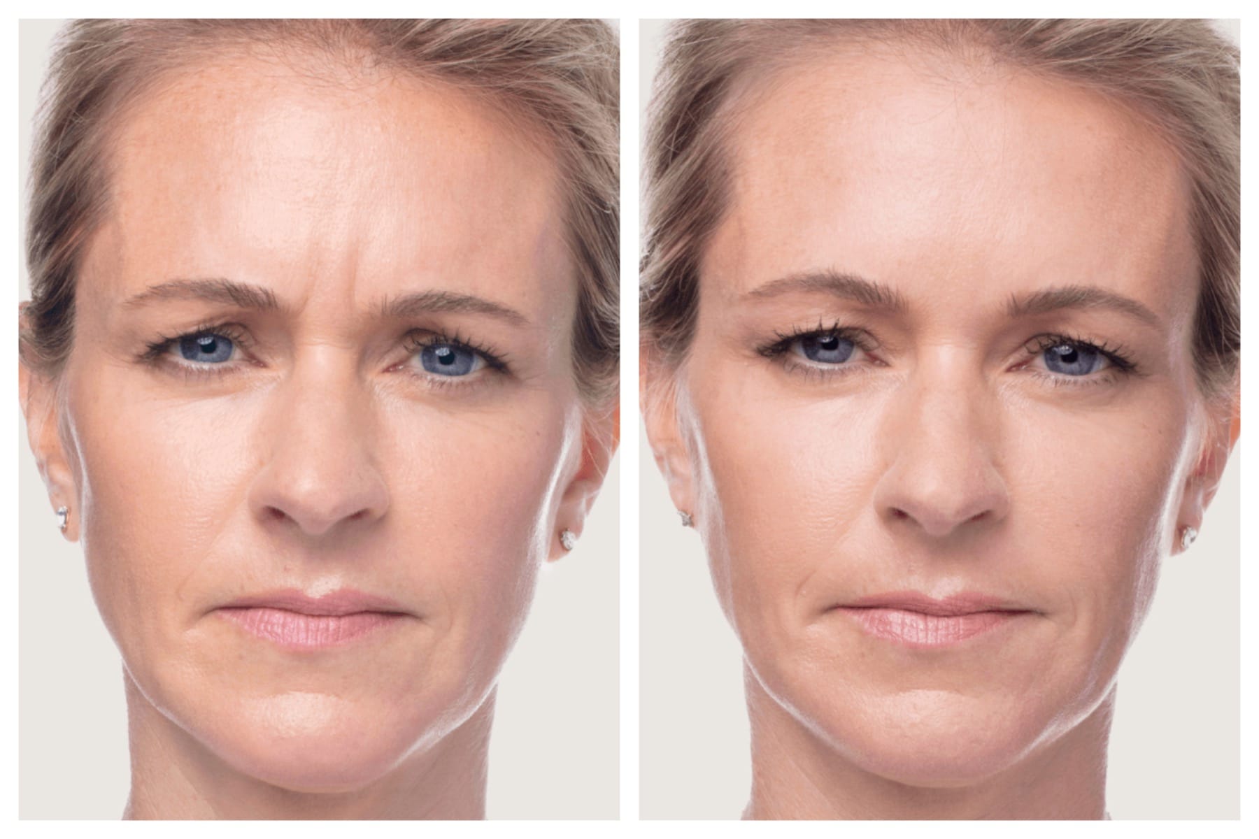 Dysport treatment